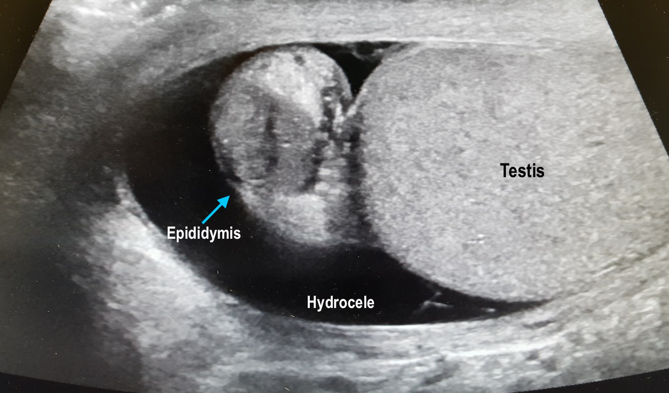 Epididymitis Lump